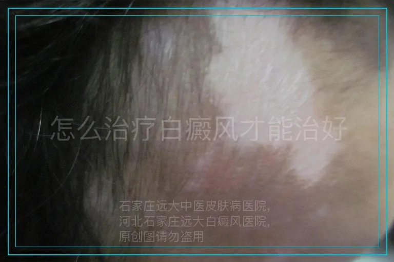 怎么治疗白癜风才能治好
