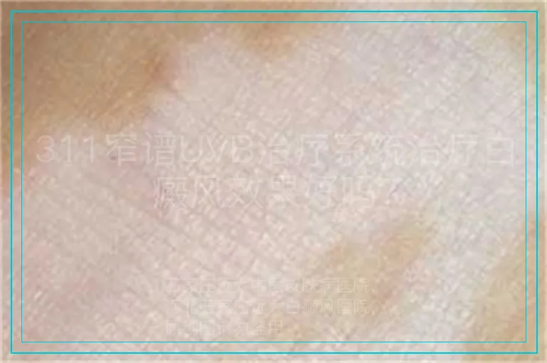 311窄谱UVB治疗系统治疗白癜风效果好吗?