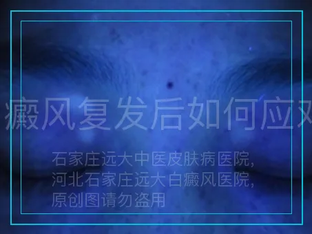 白癜风复发后如何应对?