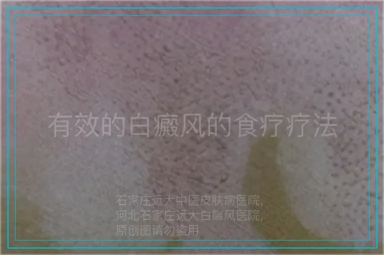 有效的白癜风的食疗疗法