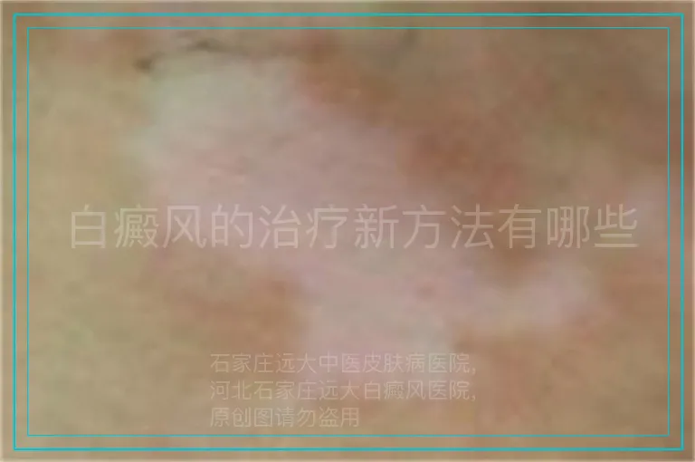 白癜风的治疗新方法有哪些