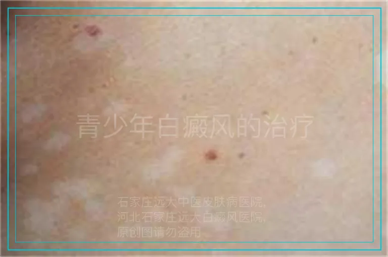 青少年白癜风的治疗