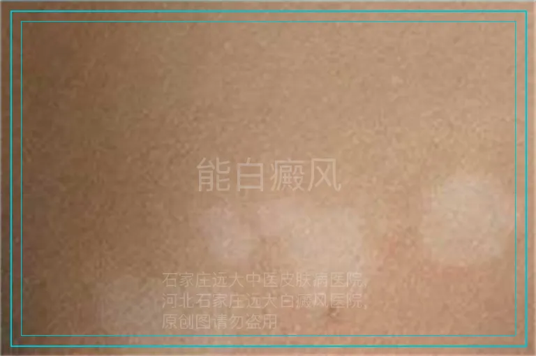能白癜风