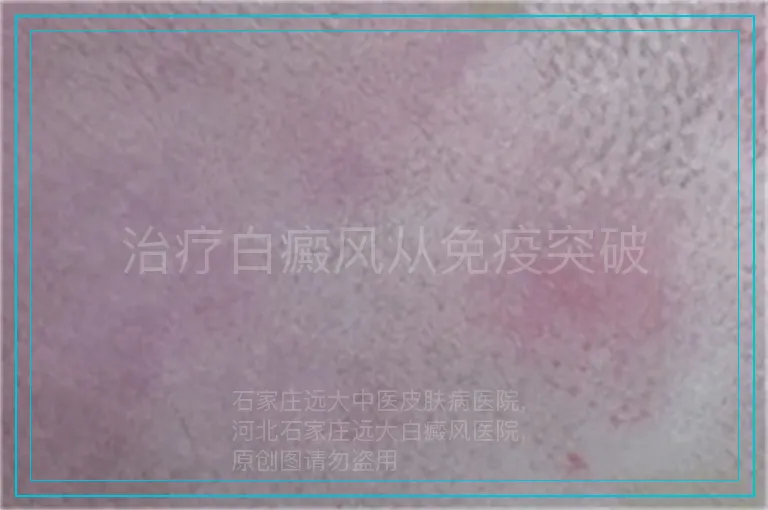 治疗白癜风从免疫突破