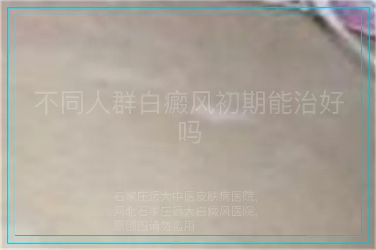 不同人群白癜风初期能治好吗