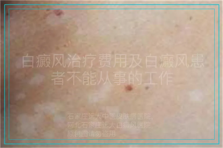 白癜风治疗费用及白癜风患者不能从事的工作
