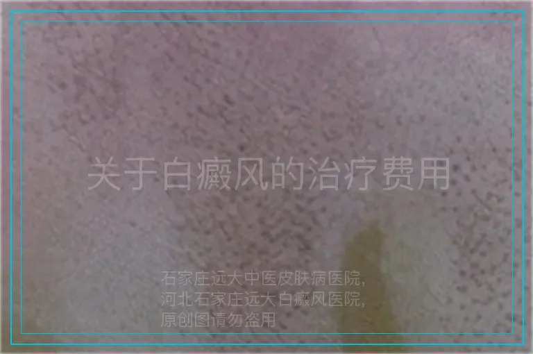 关于白癜风的治疗费用