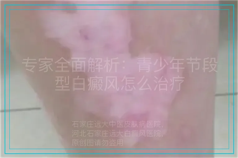 专家全面解析:青少年节段型白癜风怎么治疗