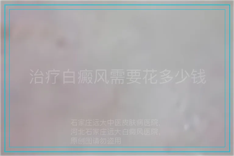 治疗白癜风需要花多少钱