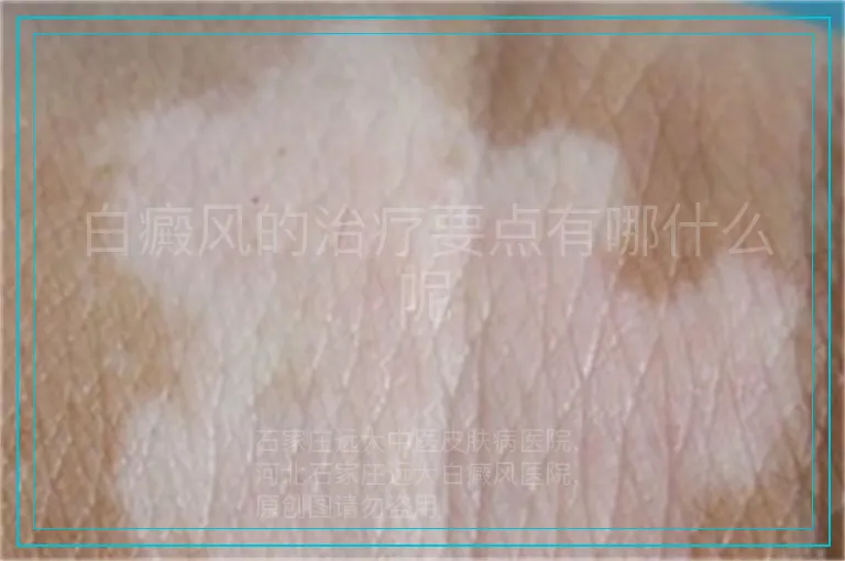 白癜风的治疗要点有哪什么呢