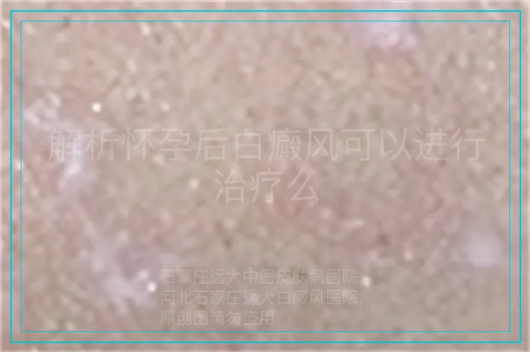 解析怀孕后白癜风可以进行治疗么