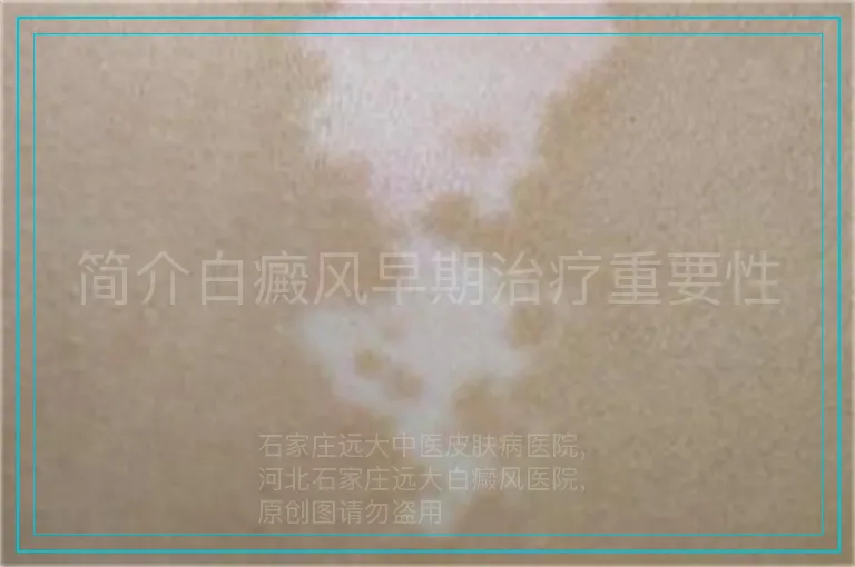 简介白癜风早期治疗重要性