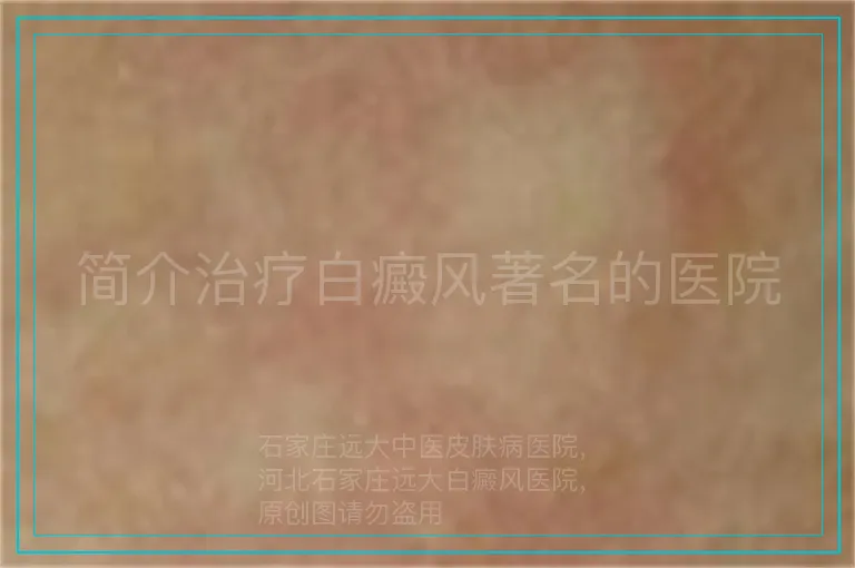 简介治疗白癜风著名的医院