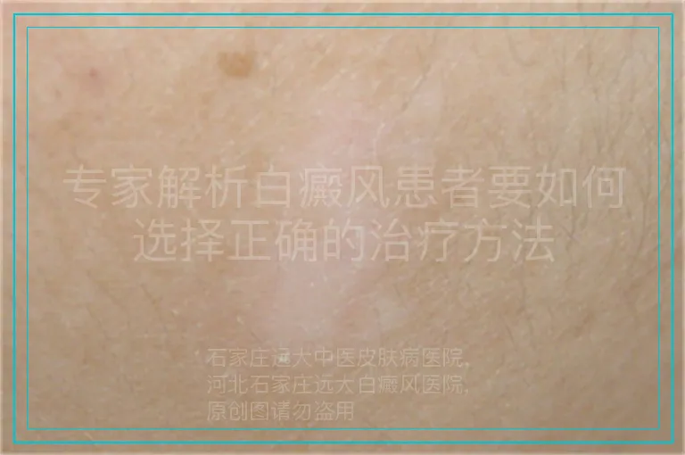 专家解析白癜风患者要如何选择正确的治疗方法