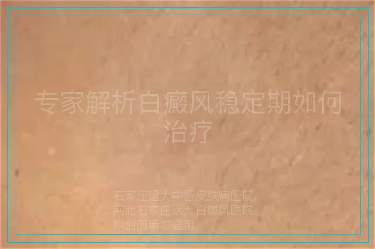 专家解析白癜风稳定期如何治疗