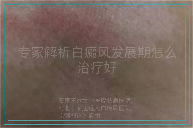 专家解析白癜风发展期怎么治疗好