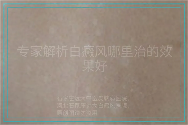 专家解析白癜风哪里治的效果好