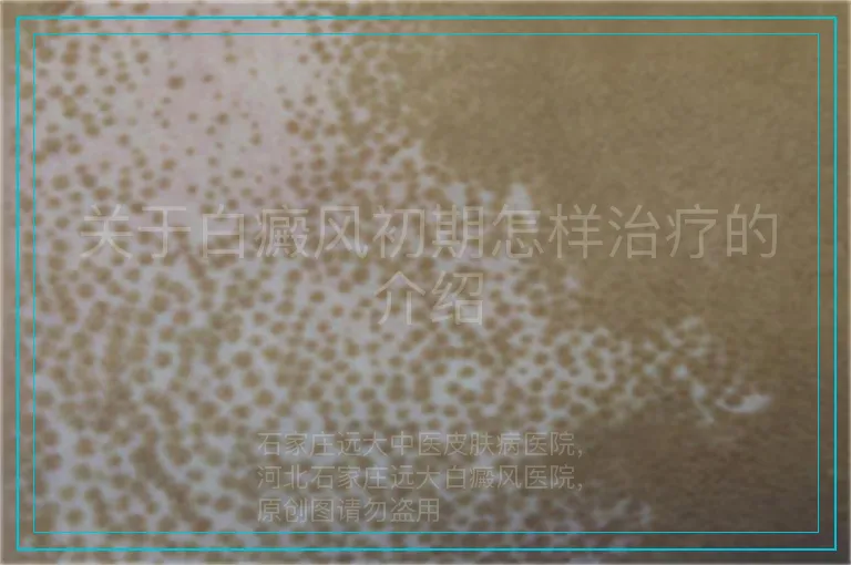 关于白癜风初期怎样治疗的介绍