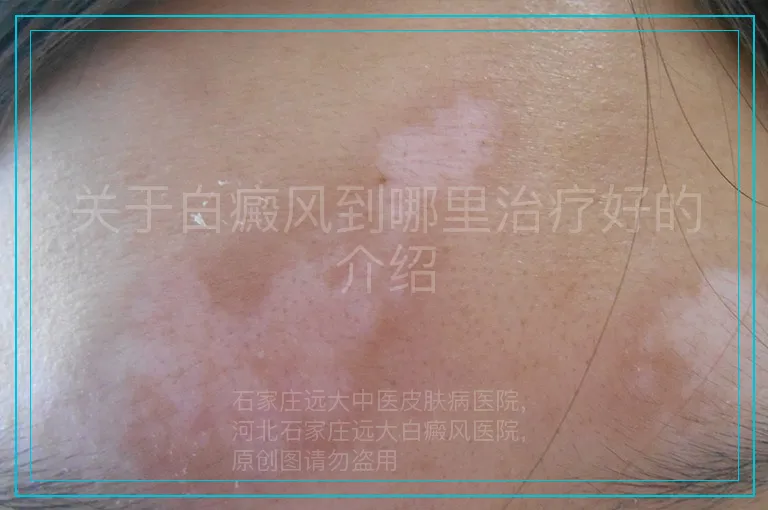 关于白癜风到哪里治疗好的介绍