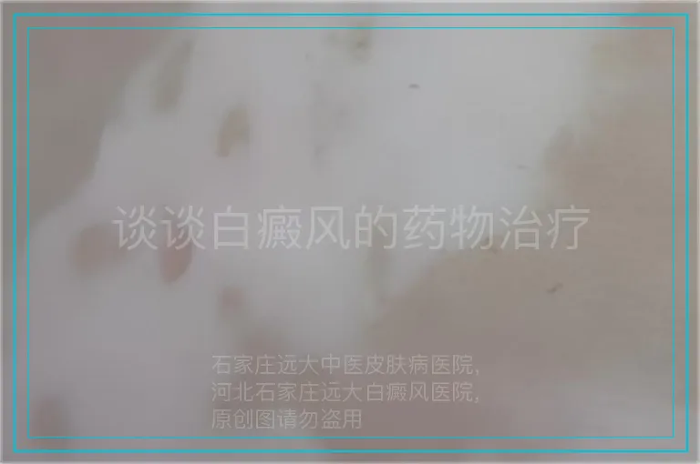 谈谈白癜风的药物治疗