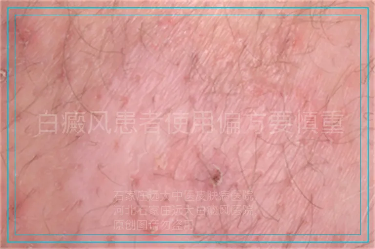 白癜风患者使用偏方要慎重