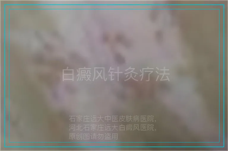白癜风针灸疗法