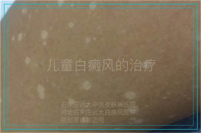 儿童白癜风的治疗