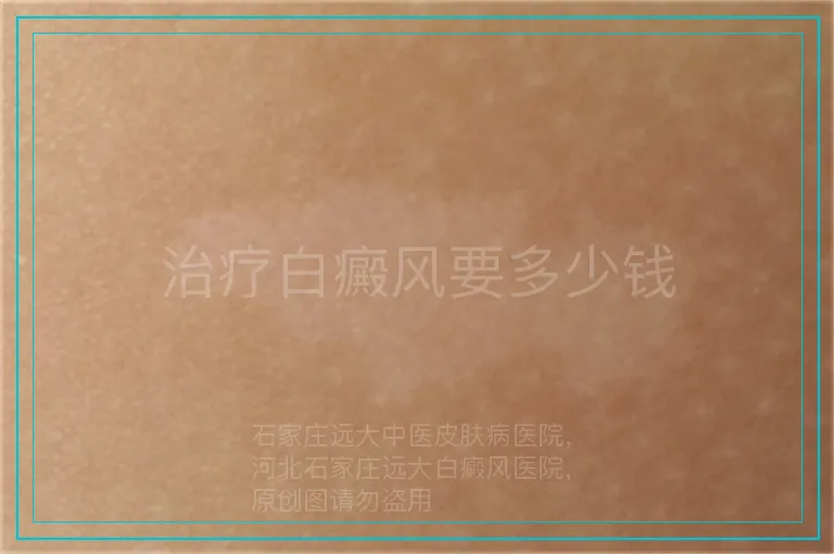 治疗白癜风要多少钱
