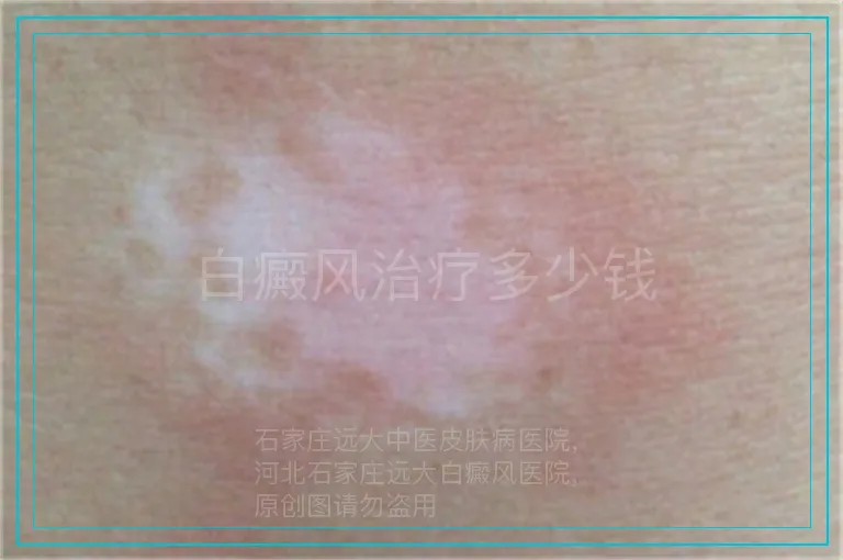 白癜风治疗多少钱