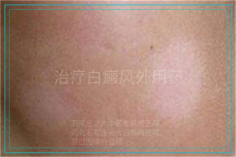 治疗白癜风外用药