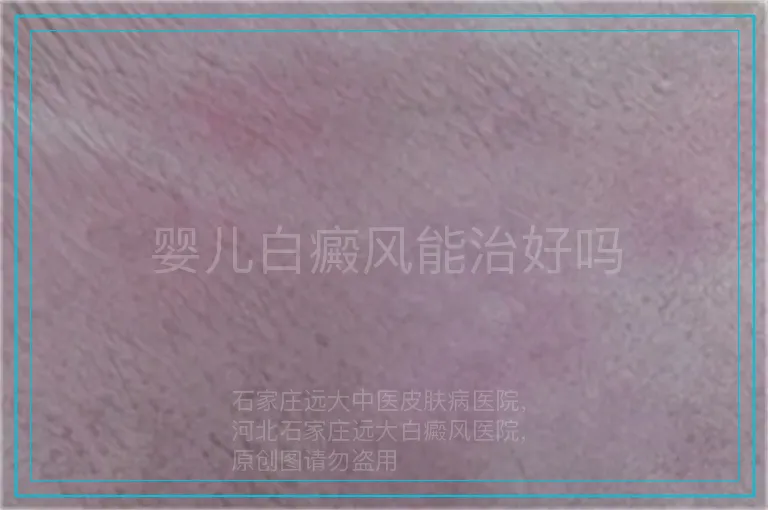 婴儿白癜风能治好吗