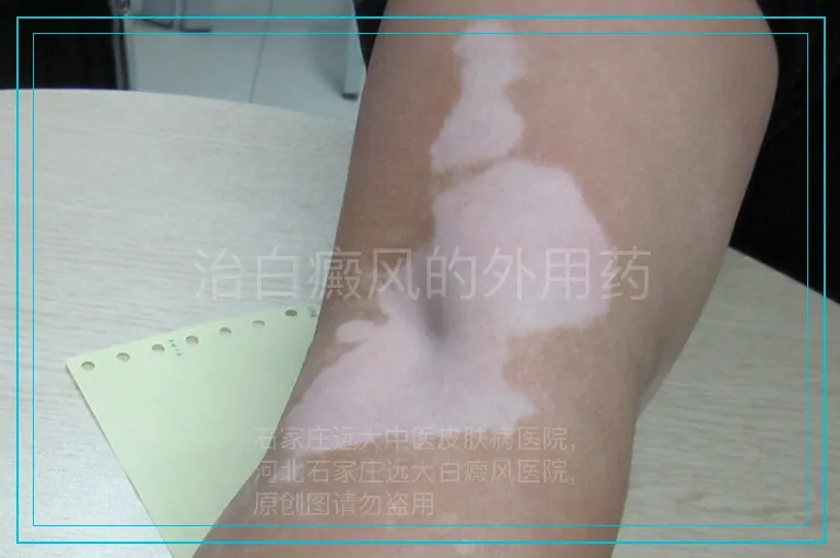 治白癜风的外用药
