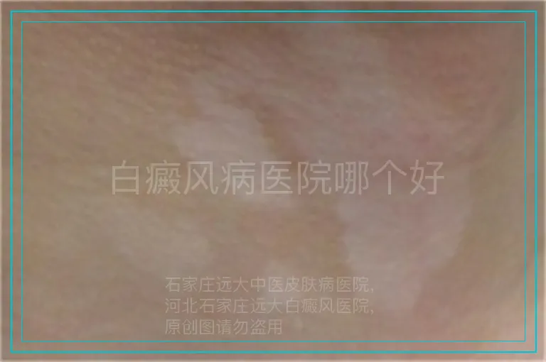 白癜风病医院哪个好