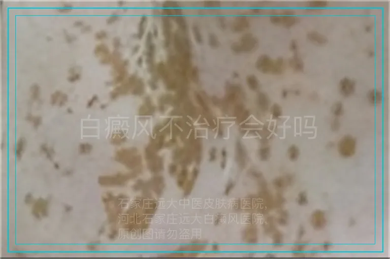 白癜风不治疗会好吗