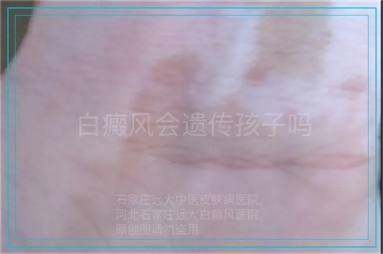 白癜风会遗传孩子吗