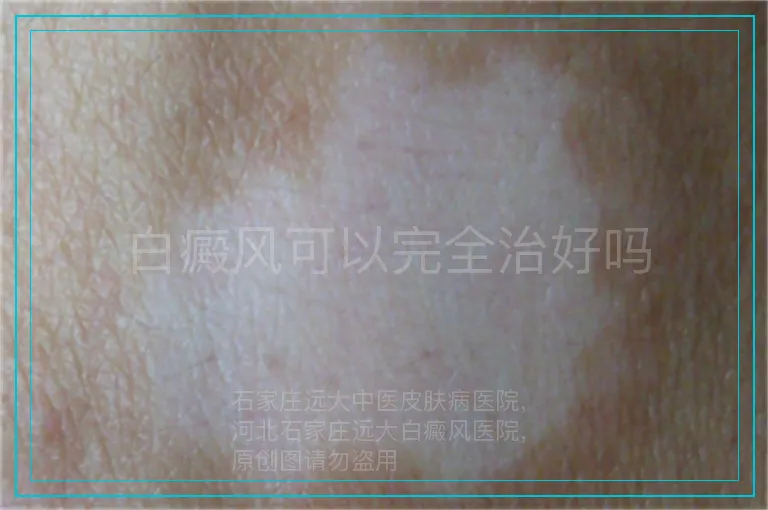 白癜风可以完全治好吗