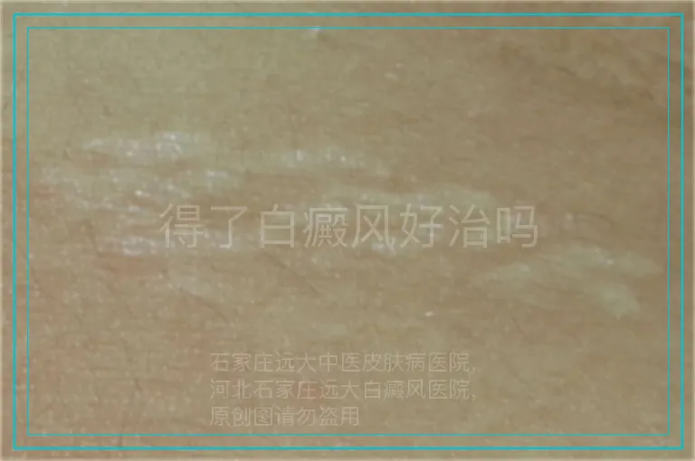 得了白癜风好治吗