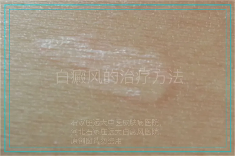 白癜风的治疗方法