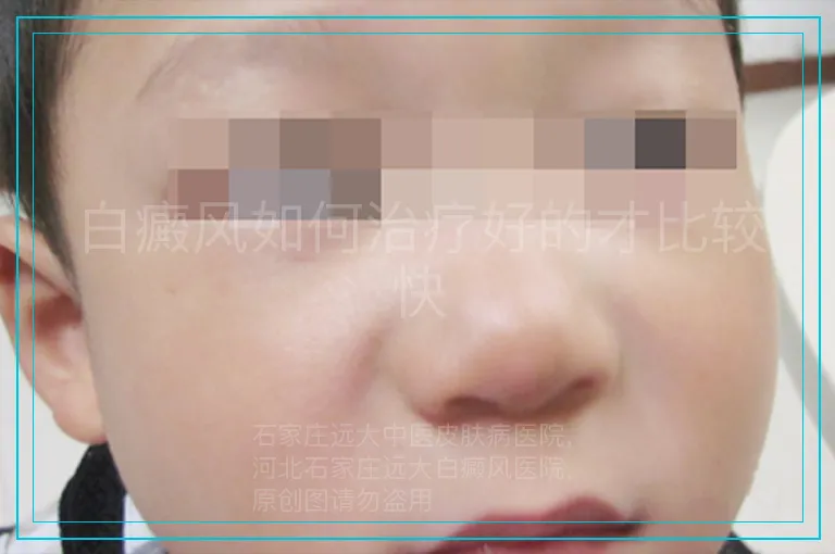 白癜风如何治疗好的才比较快