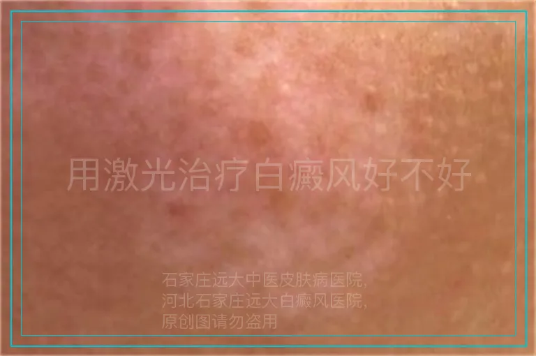 用激光治疗白癜风好不好