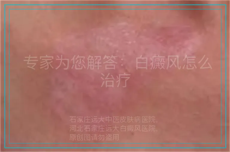  专家为您解答：白癜风怎么治疗