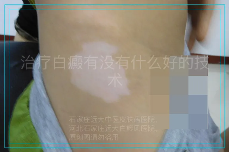 治疗白癜有没有什么好的技术