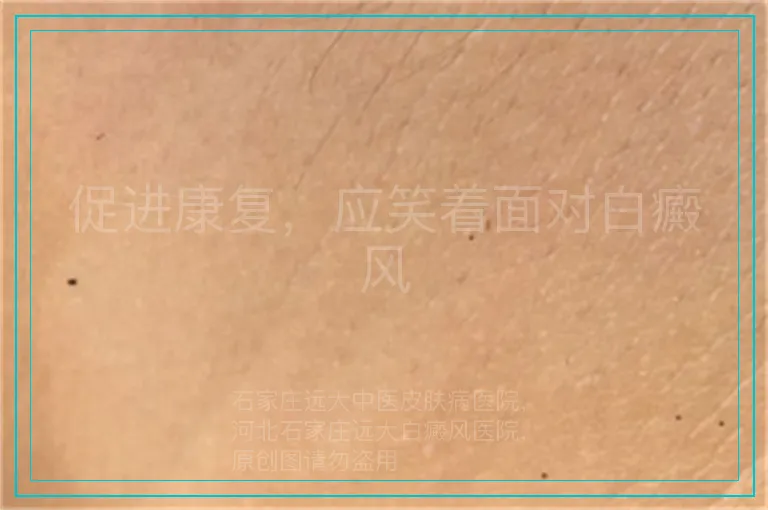 促进康复,应笑着面对白癜风
