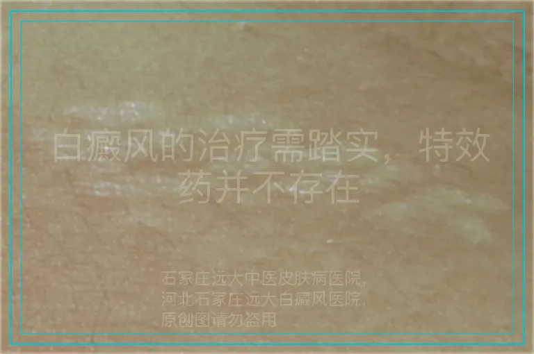 白癜风的治疗需踏实,特效药并不存在