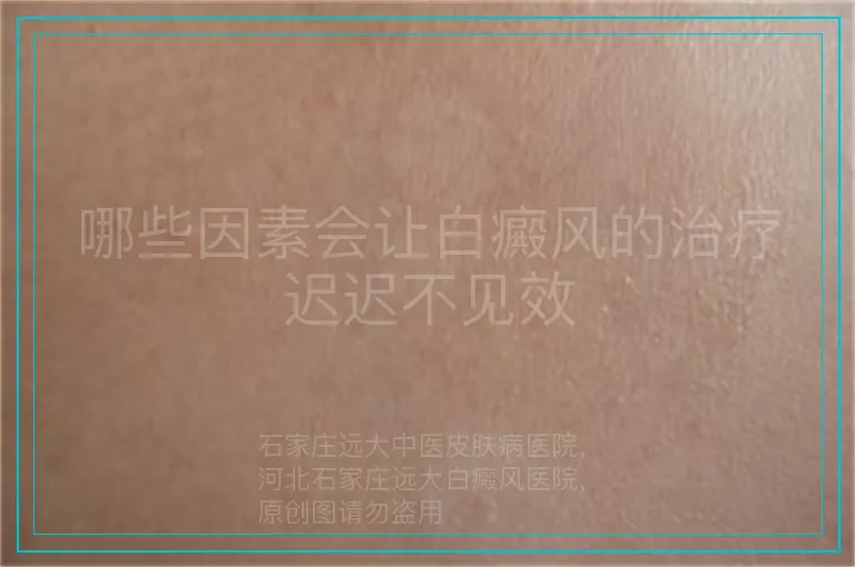 哪些因素会让白癜风的治疗迟迟不见效