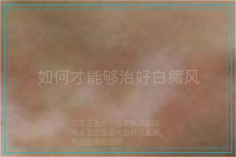 如何才能够治好白癜风