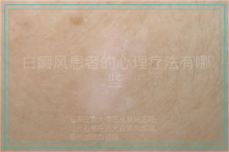 白癜风患者的心理疗法有哪些