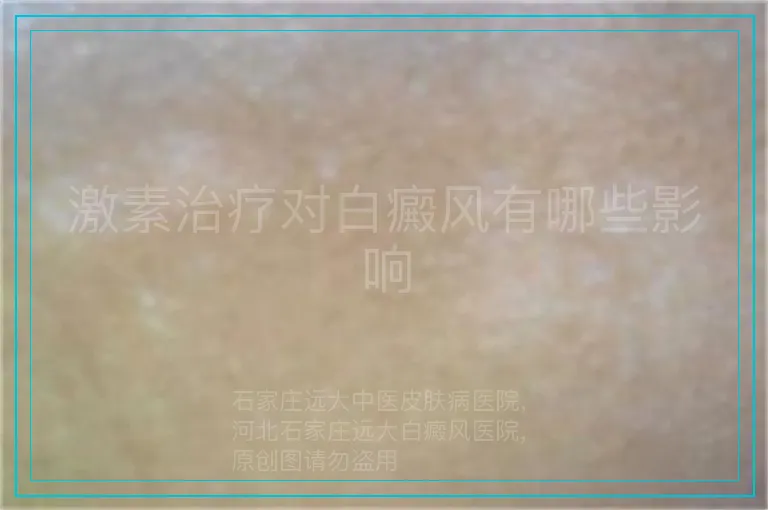 激素治疗对白癜风有哪些影响