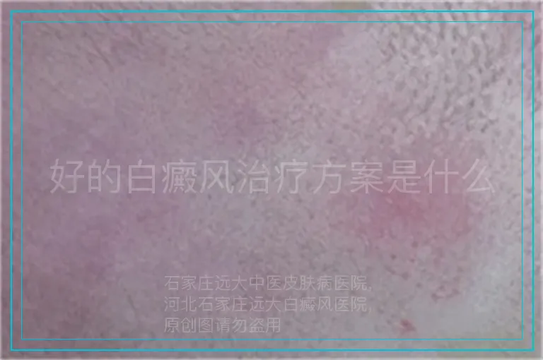 好的白癜风治疗方案是什么