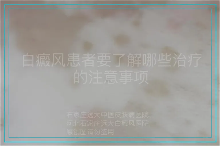 白癜风患者要了解哪些治疗的注意事项